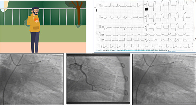 Coronary Artery Disease (CAD)