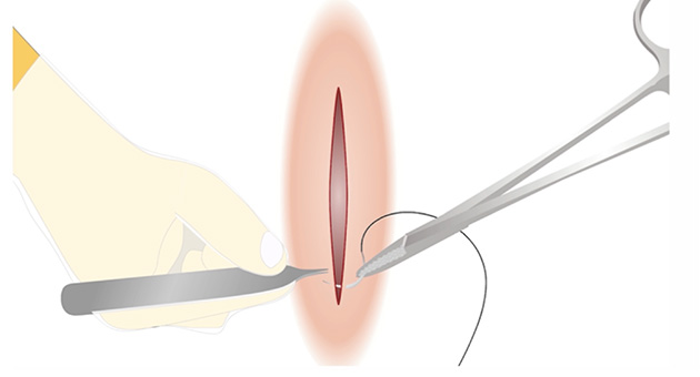 Basic Surgical Suturing