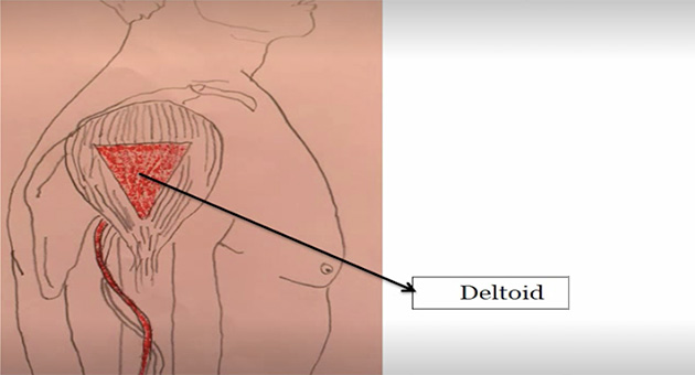 Intramuscular Injection