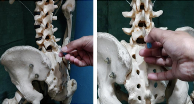 Diagnostic Lumbar Puncture