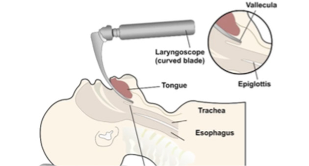 Endotracheal Intubation