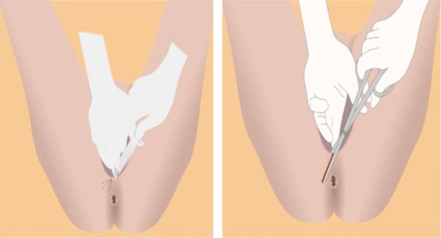 Episiotomy Repair 