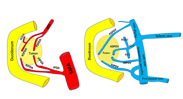 Whipple Procedure