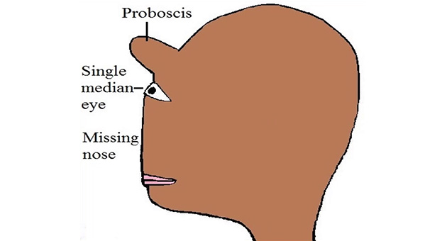 Anomalies of Development of Face