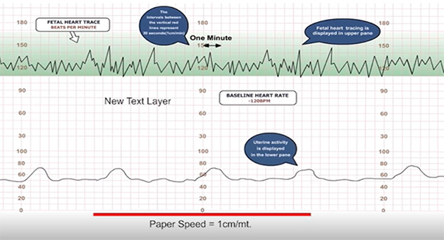 Interpretation of CTG