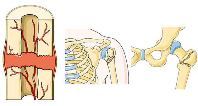 Mechanism of Fractures