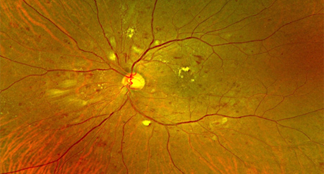 Clinical Features and Management of Diabetic Retinopathy