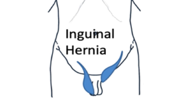 Inguinal Hernia 