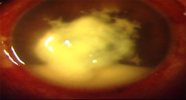 Clinical Features and Management  of Keratitis