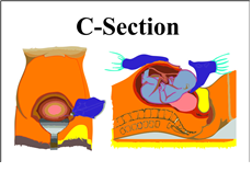 Care During Step C-Section