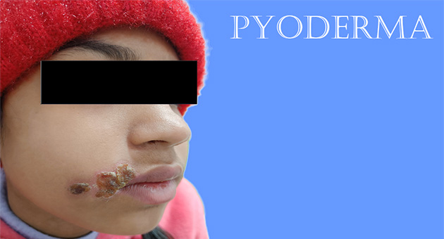 Pyoderma