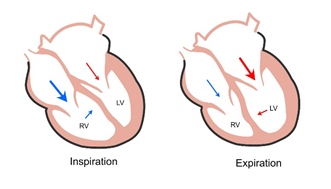 Chronic Constrictive Pericarditis