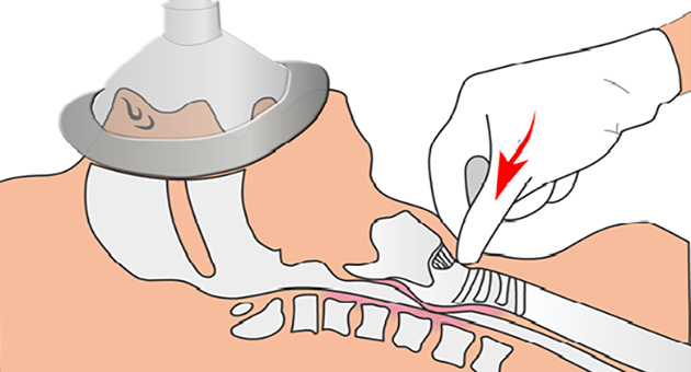 Rapid Sequence Induction and Intubation