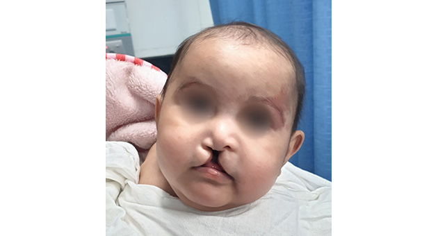 Cleft Lip & Palate