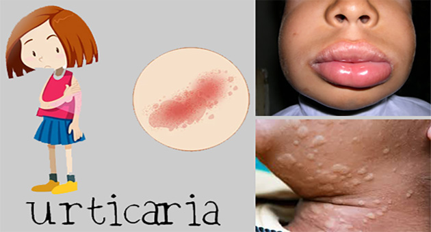 Urticaria and Angioedema