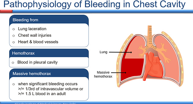 Pathophysiology of Traumatic Chest Injuries