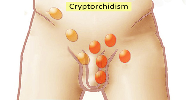 Undescended Testis