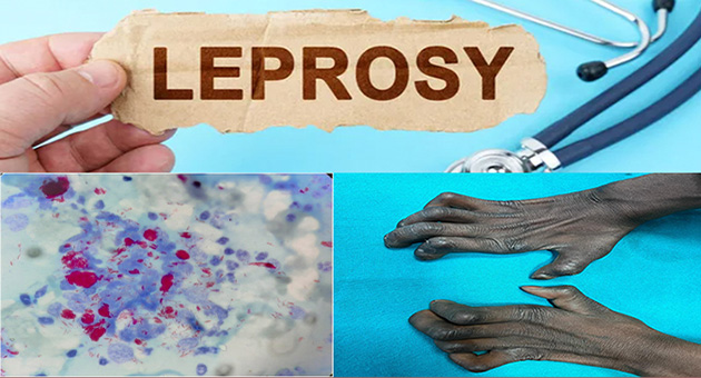 Leprosy