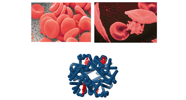 Disorders of Hemoglobin Structure and Function