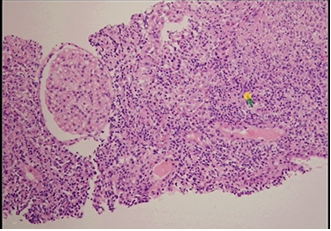 Interstitial Nephritis