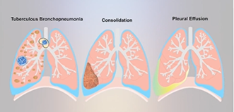 Pathogenesis of Pulmonary Tuberculosis