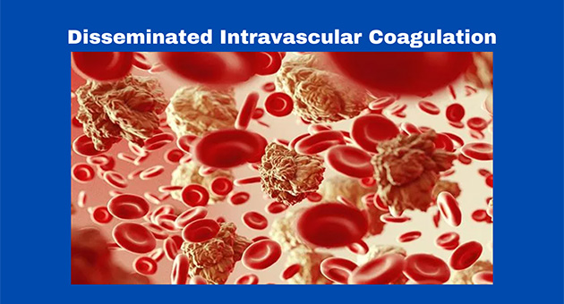 Disseminated Intravascular Coagulation