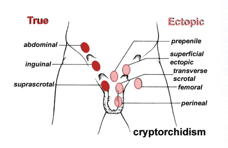 Cryptorchidism