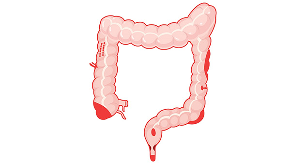 Approach to Lower Gastrointestinal Bleed