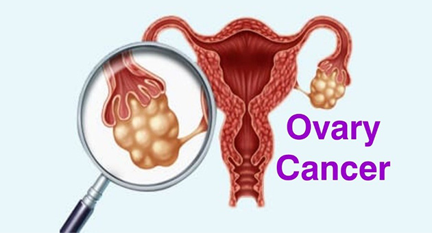 Ovary Cancer 