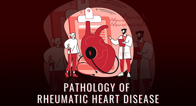 Pathology of Rheumatic Heart Disease