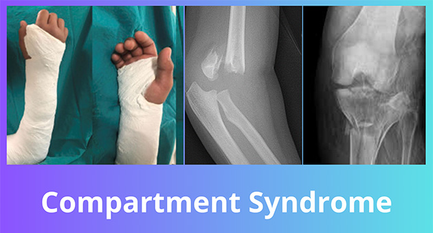 Compartment Syndrome