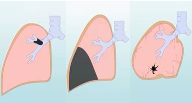 Lung Atelactasis