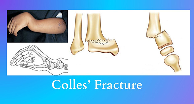 Colles’ Fracture