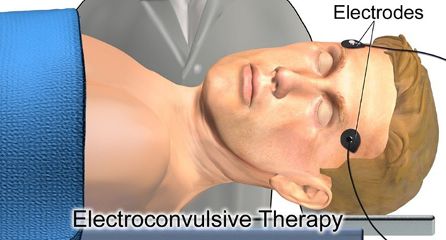 Electroconvulsive Therapy