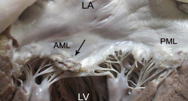 Infective Endocarditis