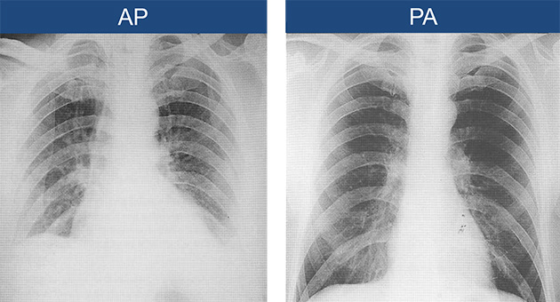 Interpretation of Chest X-Ray