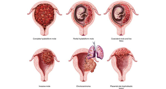 Gestational Trophoblastic Neoplasia