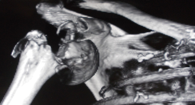 Proximal Humerus Fractures