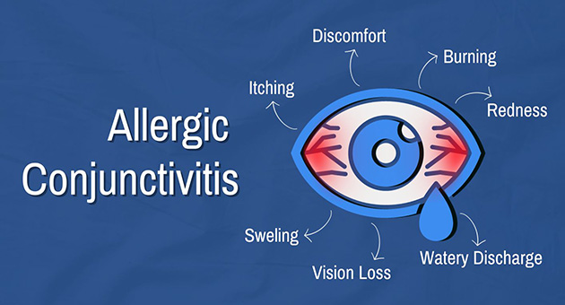 Allergic Conjunctivitis