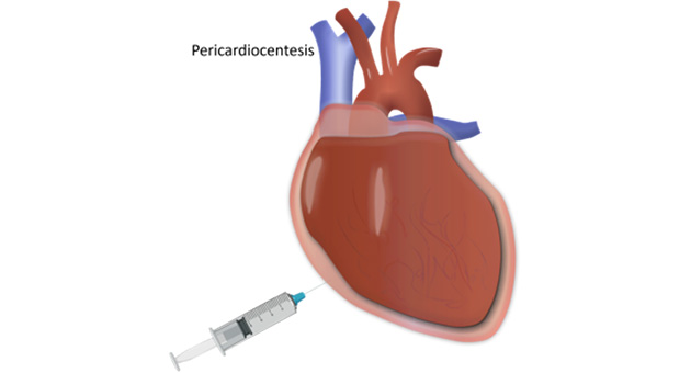 Pericardiocentesis