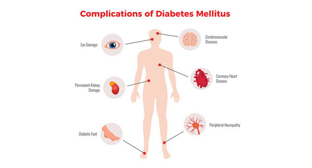 Treatment and Management of Complication of Diabetes