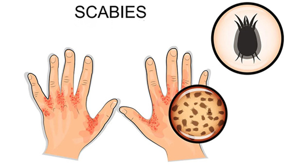 Scabies