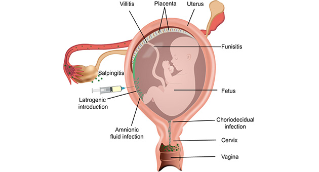 Preterm Labour