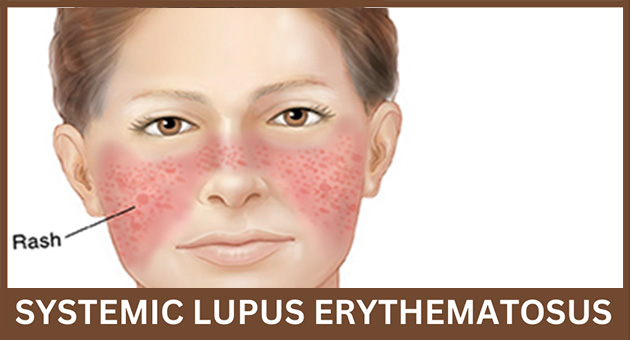 Systemic Lupus Erythematosus